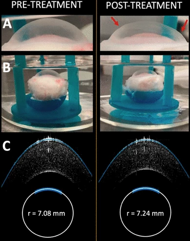 The rabbit cornea before and after EMR treatment; the radius of curvature (C) shows a −3.12 diopter change in the refractive power of the cornea