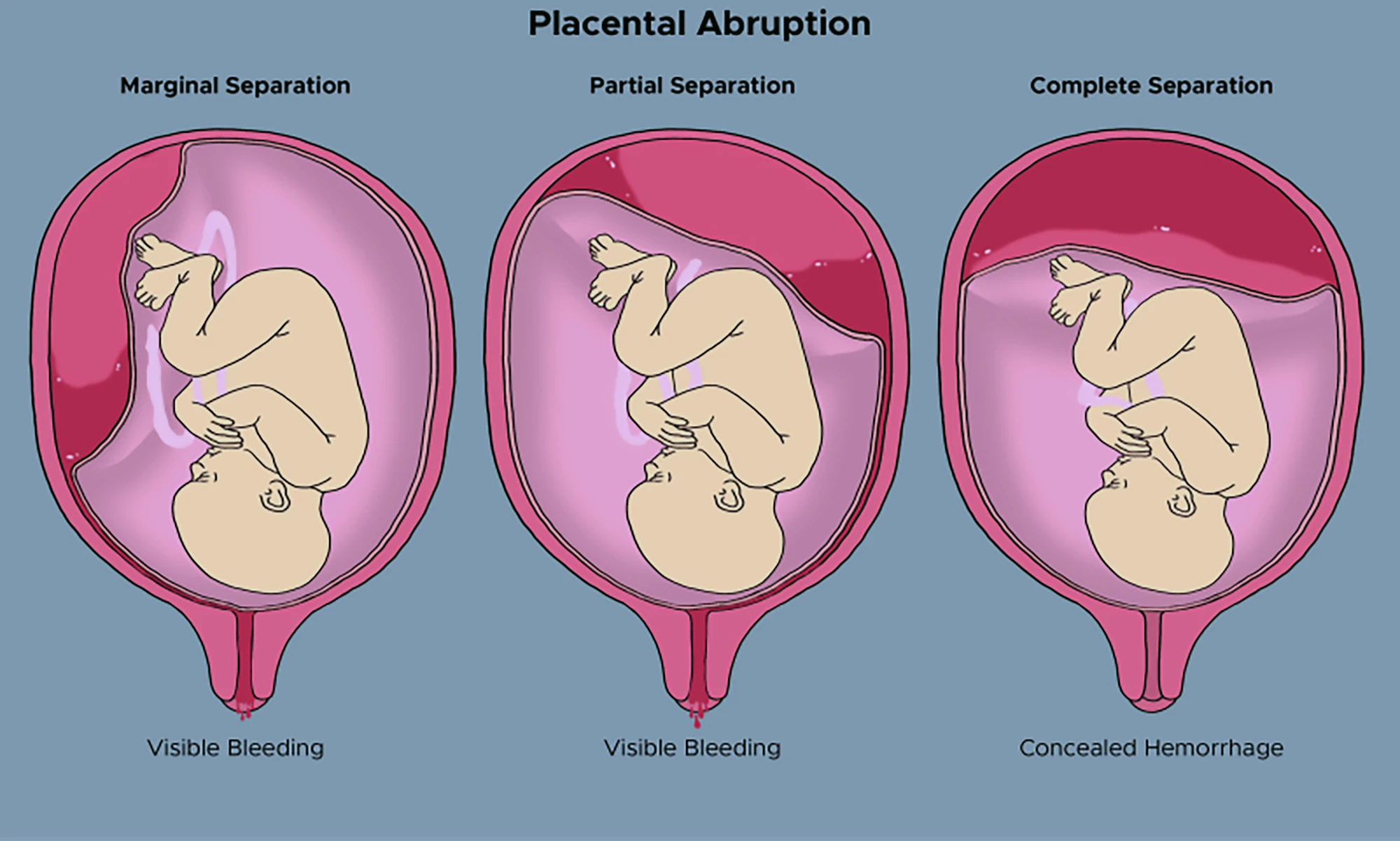 Types of placental abruption