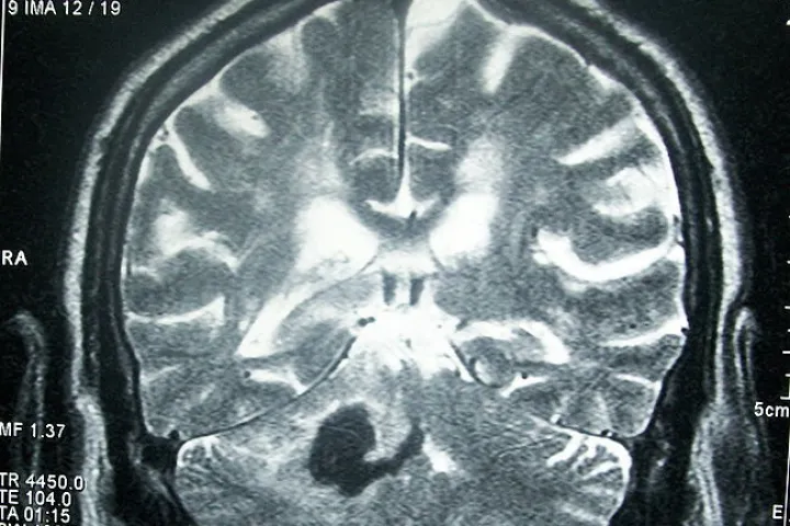 An experimental new stroke treatment replicates and enhances the brain's natural reaction to being in an enriched, stimulating environment (Image: Bobjgalindo)