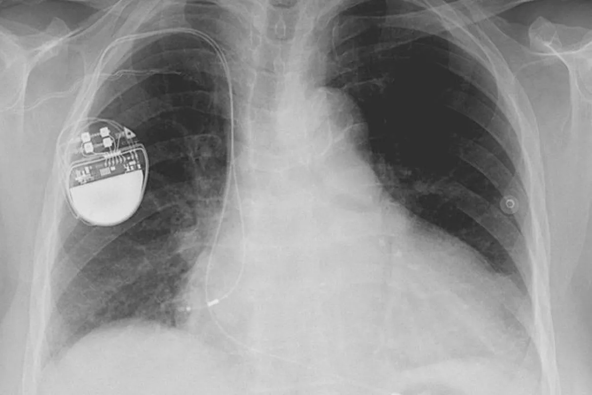 Scientists from MIT are designing a wearable signal jamming system, to protect implantable medical devices (such as this pacemaker) from wireless attacks (Image: Lucien Monfils)