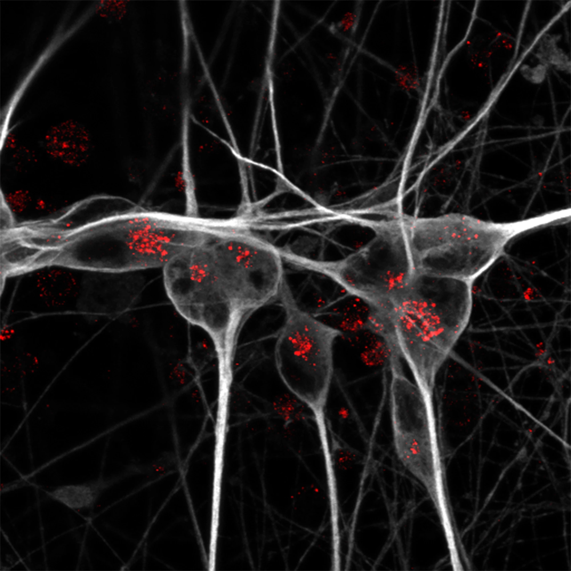 The "normal" (APOE3) variant allows lipids used by neurons for energy; the APOE4 variant stops that happening