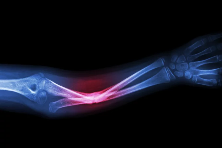 Polymer spheres were used to deliver microRNA molecules to cells at the site of the injury, which were then directed to aid in the healing process