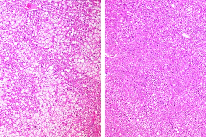 Fat deposits seen in white in liver tissue of untreated mice on the left, compared to mice treated with ADI-PEG 20 on the right