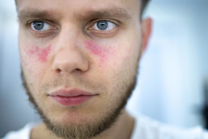 Researchers have pinpointed a genetic mutation that can lead to lupus