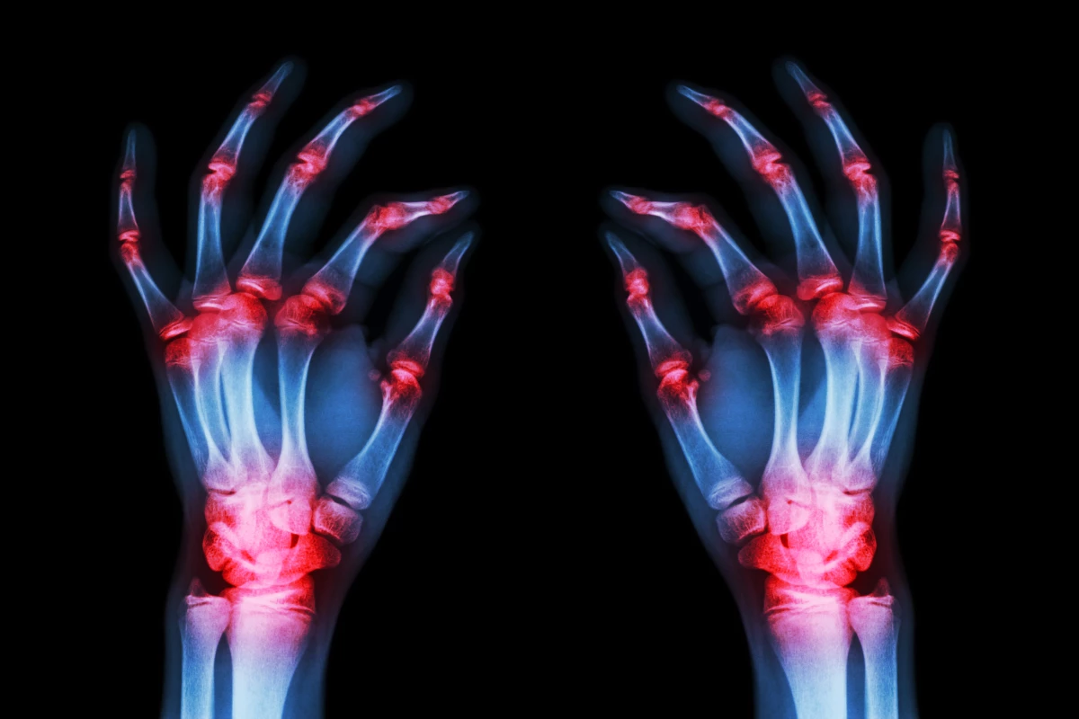 The research is still in preliminary stages but if further validated it could lead to new classes of drugs to treat rheumatoid arthritis
