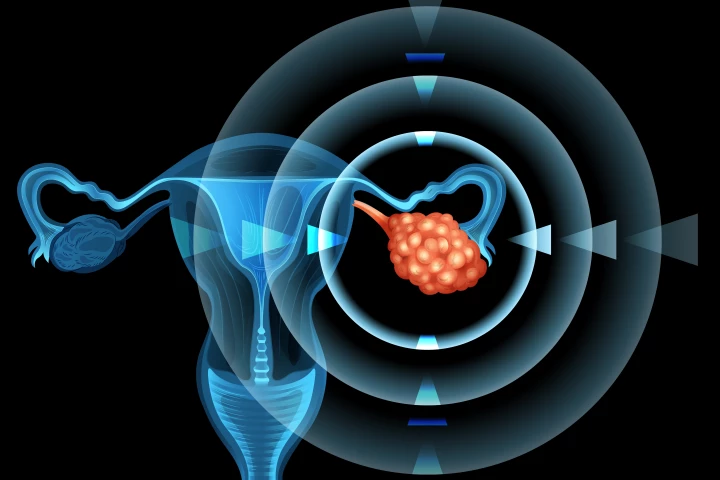 Ovarian cancer is the most deadly cancer of the female reproductive system