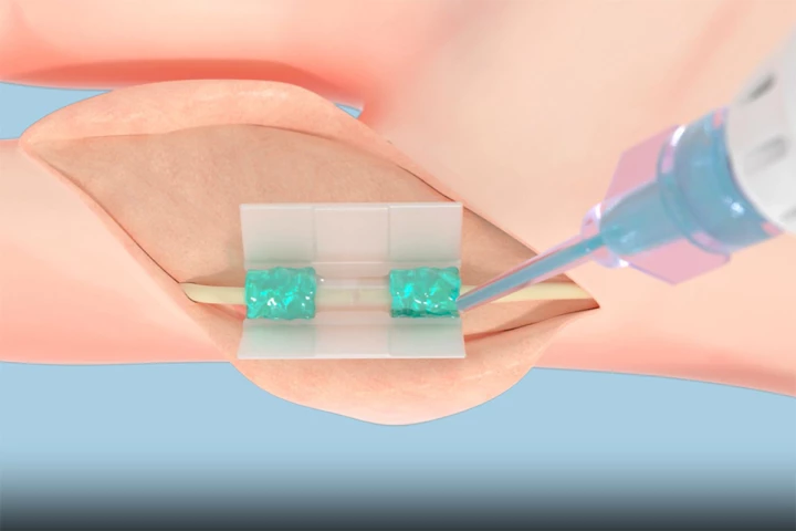 Tissium's biocompatible polymers (the blue, gel-like substance in this rendering) that conform to tissues and a 3D-printed chamber (clear tube at center) surrounding a nerve in a finger