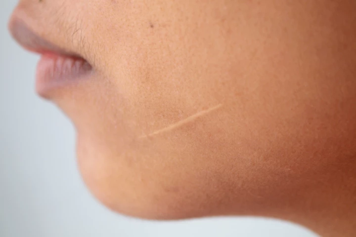 Scar tissue is typically stiffer than regular skin, plus it lacks hair follicles and blood vessels