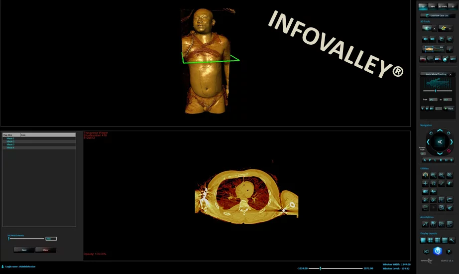 Multi-planar reconstructions tracking metal using the digital autopsy software