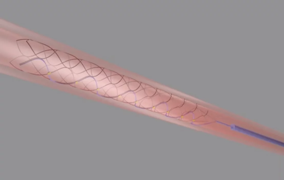 Barely the size of a paperclip, the new stentrode transmitting device is said to be able to allow people to use their own thoughts to control exoskeletons or prosthetic limbs