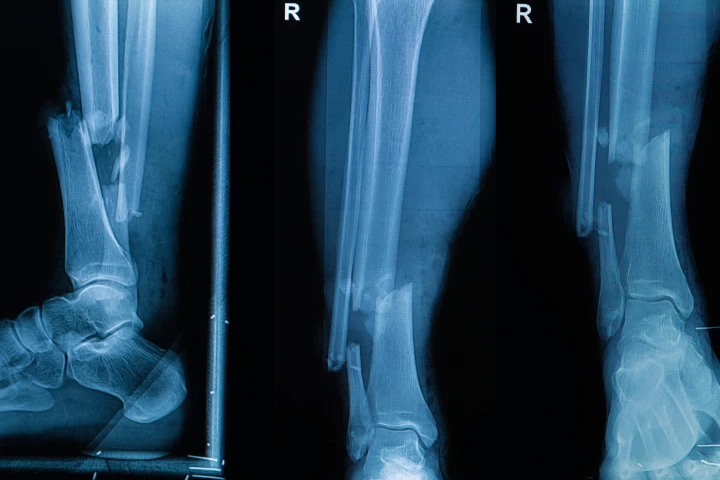 A modified glue gun prints bone grafts directly onto fractures during surgery