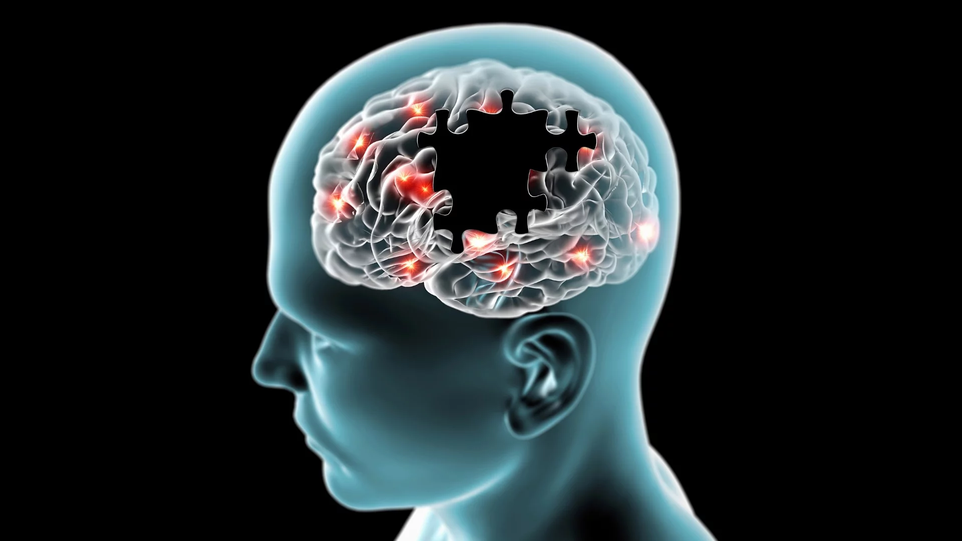 New research has revealed frontotemporal dementia results in a person losing the ability to daydream or let their mind wander