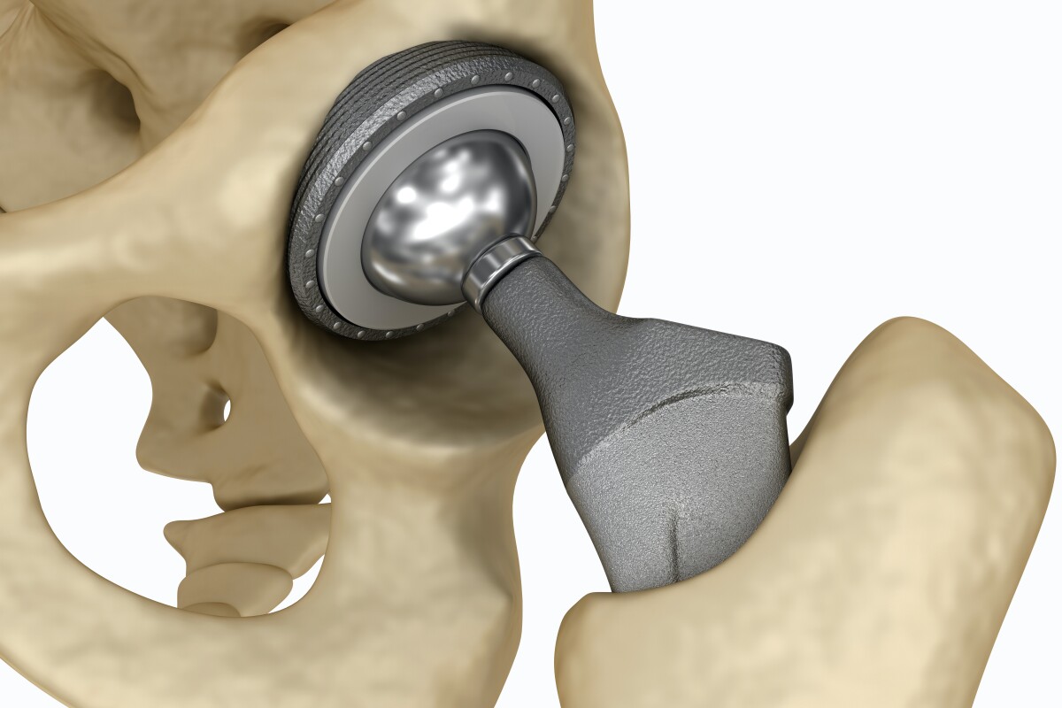 Although initially proposed for use on artificial hips, the technology could reportedly also find use in dental, jaw and knee implants