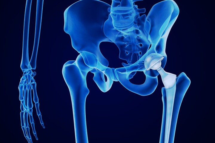 Bone cement plays an important role in anchoring artificial joints in place, and a new version may better protect against bacterial infections at the same time