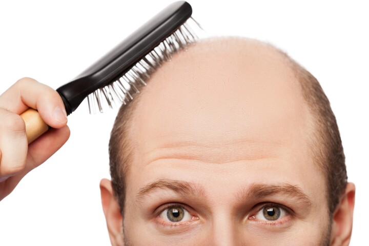 New research has identified rare genetic variants associated with male pattern hair loss