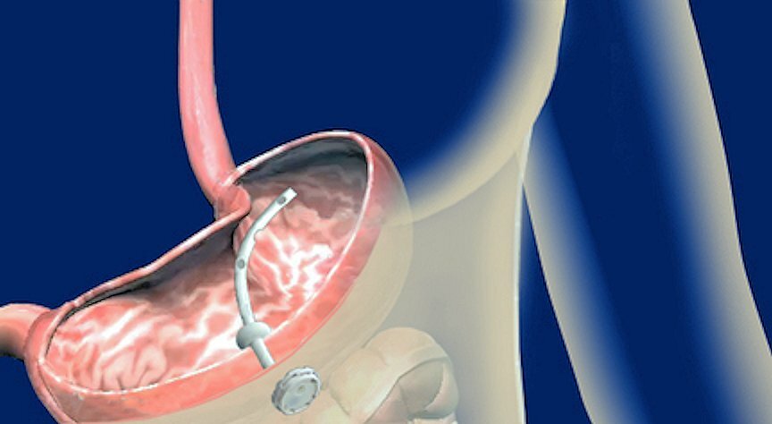 The AspireAssist stomach tube and port installed in a patient's stomach and abdominal wall (Photo: Aspire Bariatrics)