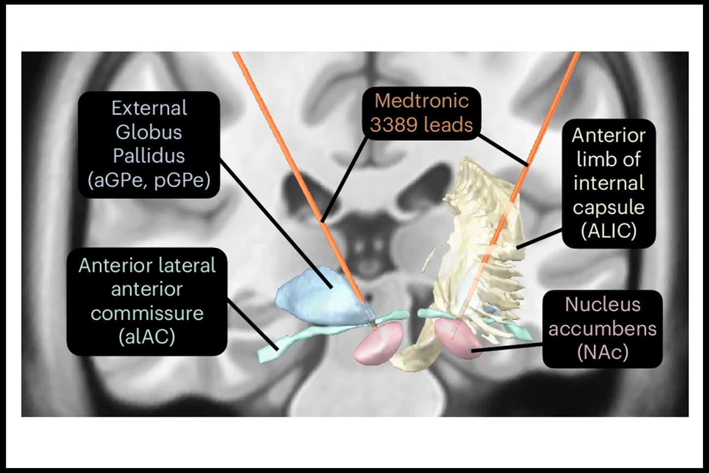 Brain anatomy and placement of the specialized DBS electrodes