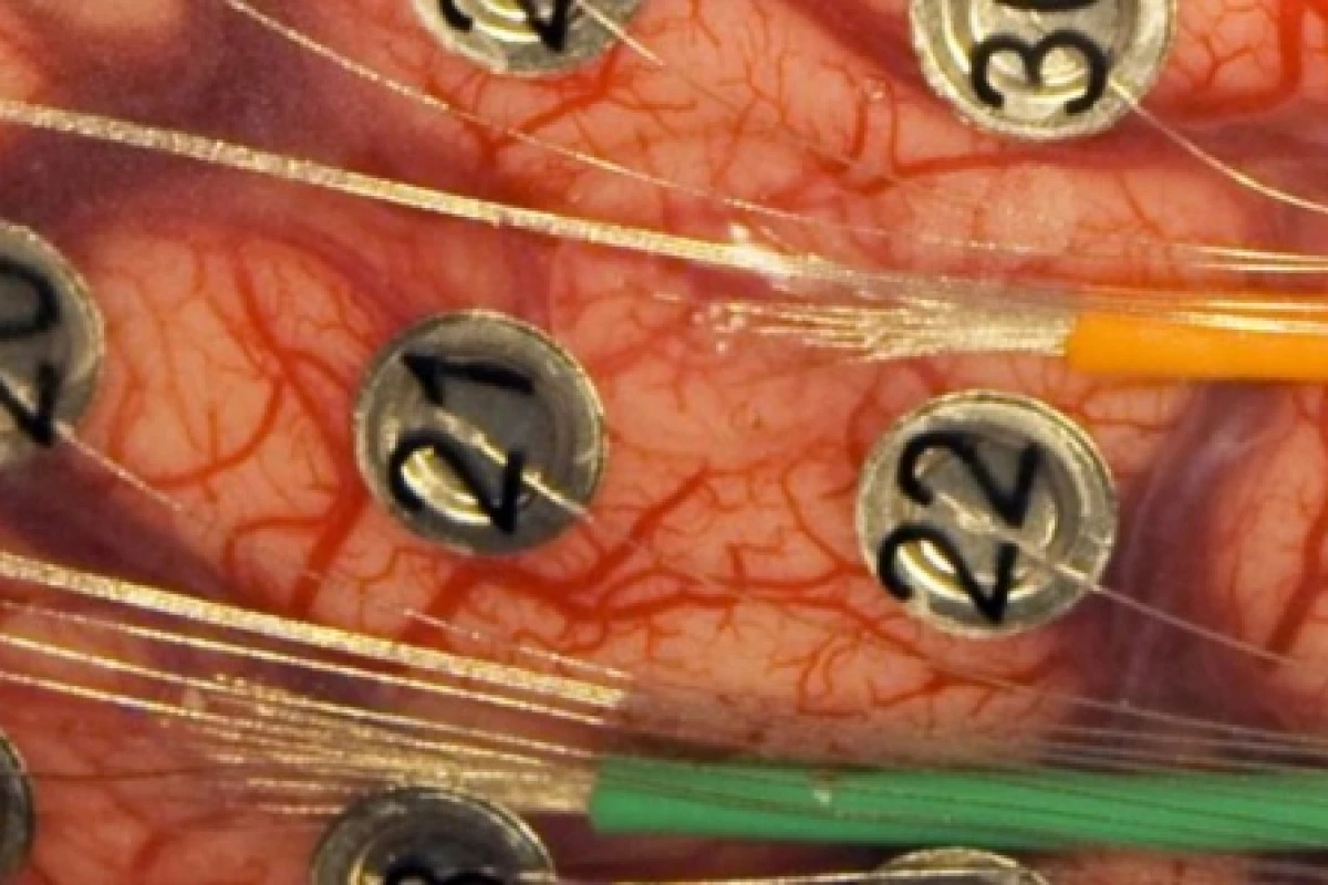 Microwires emerging from the green and orange tubes connect to two arrays of 16 microelectrodes embedded in a small mat of clear, rubbery silicone - the larger, numbered electrodes are part of the patient’s original surgery (Photo: University of Utah Department of Neurosurgery)