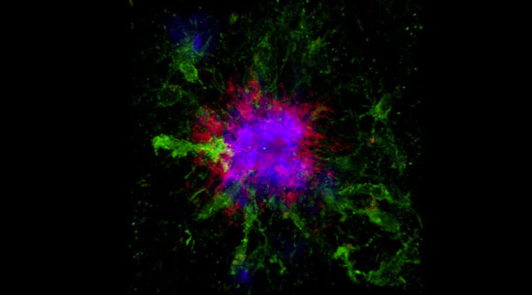 This confocal microscopy image shows amyloid plaques (blue and red) in the brain of a mouse – the accumulation of amyloid plaques is so far the most well-documented biochemical hallmark of Alzheimer’s disease
