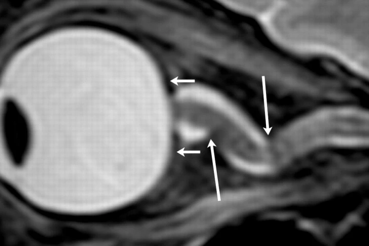 MR image showing changes in eye structure after long-duration spaceflight