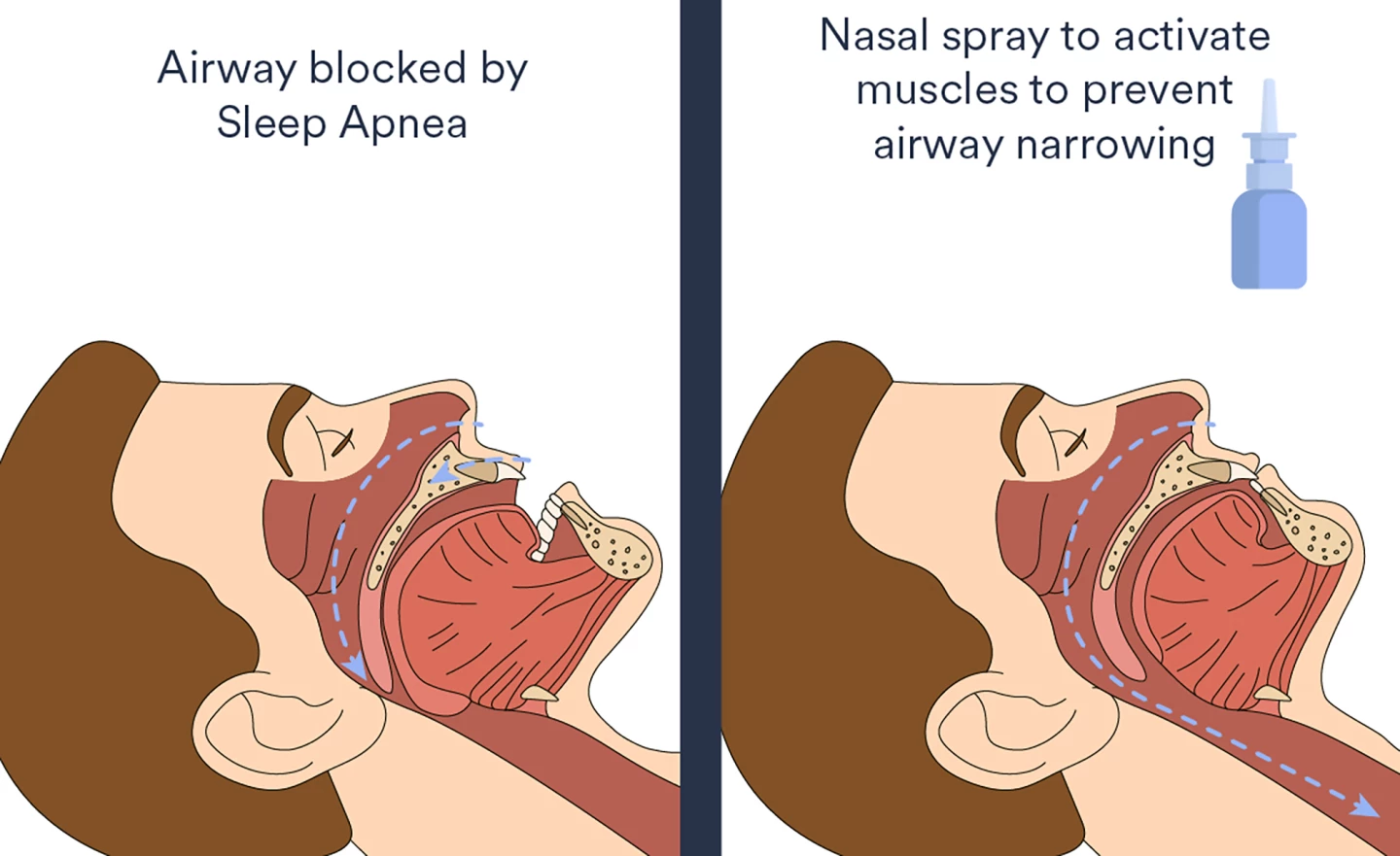 The nasal spray reduced OSA severity by acting on the muscles that keep the throat and upper airways open