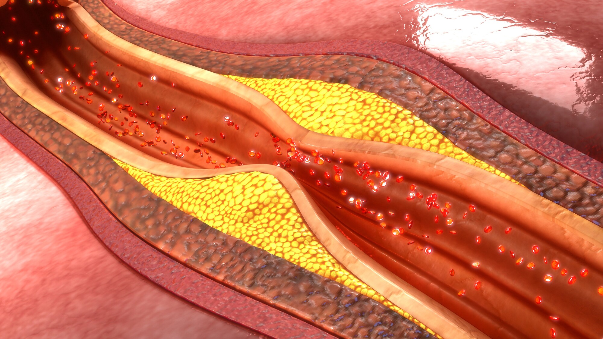 Infusions of nanoparticles that selectively target certain immune cells show promise in animal tests for clearing out arterial plaques