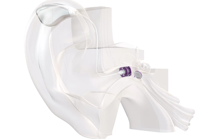 A diagram showing the alpha hearing aid installed inside a user's ear canal
