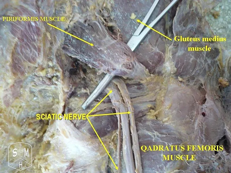 Surgical exposure of the sciatic nerve