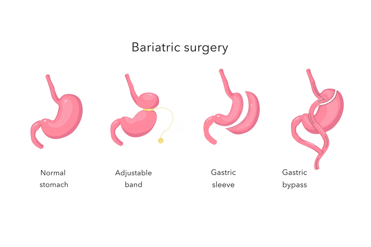 Types of bariatric surgery