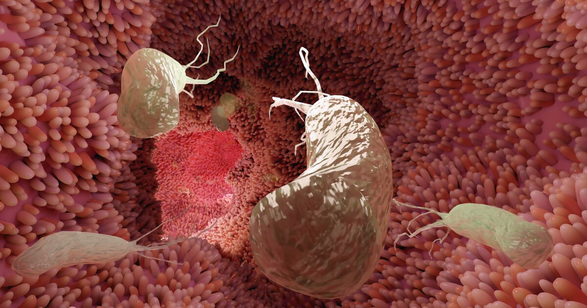Stomach cancer prevention through H. pylori treatment Stomach cancer prevention through H. pylori treatment