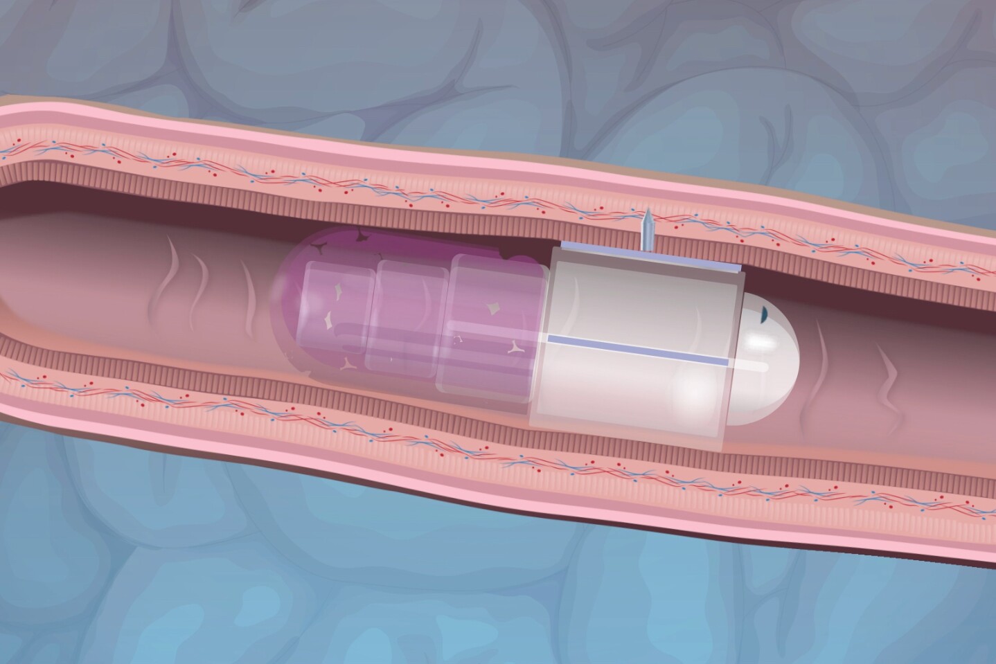 An x-ray view of the RaniPill deploying its microneedle