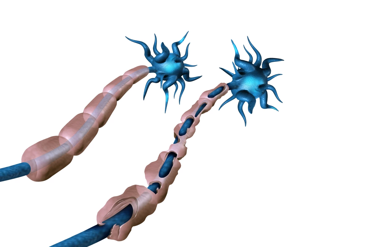 A new study has shown that transplanting certain brain cells can reverse the damage caused by multiple sclerosis
