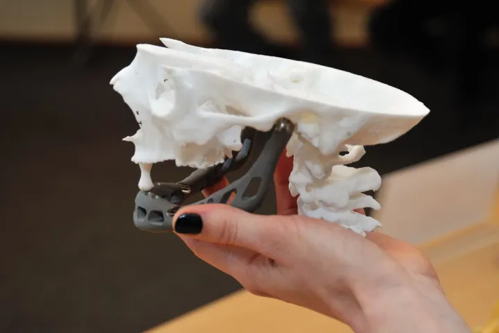 An 83-year old woman is the first in the world to receive a full 3D-printed titanium lower jaw implant