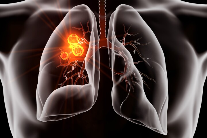 A clinical trial of a new lung cancer pill has produced remarkable results