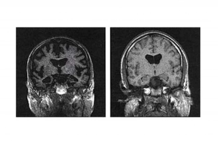 MRI of a brain with A.D. (left) and a normally aged brainImage credit: NASA