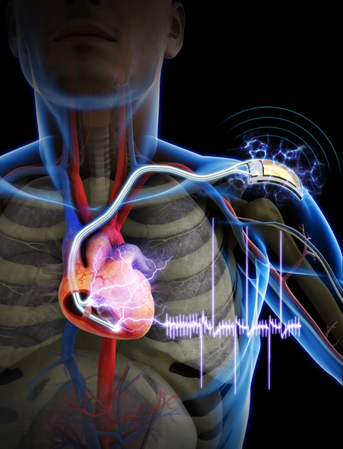 A group of researchers has developed a pacemaker powered by an implantable flexible piezoelectric nanogenerator