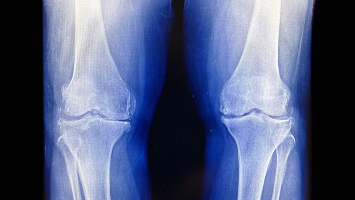 Low-dose radiation relieves knee osteoarthritis pain, improves function
