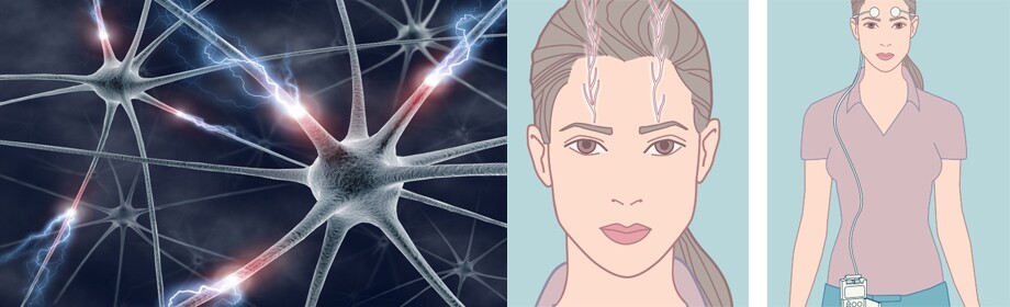 It may be possible to treat depression without drugs, by electrically stimulating the trigeminal nerve via external or subcutaneous electrodes (Image: NeuroSigma)