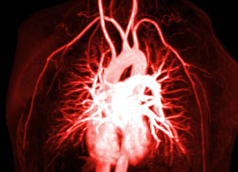 Angiogram of blood vessels in and around the heart