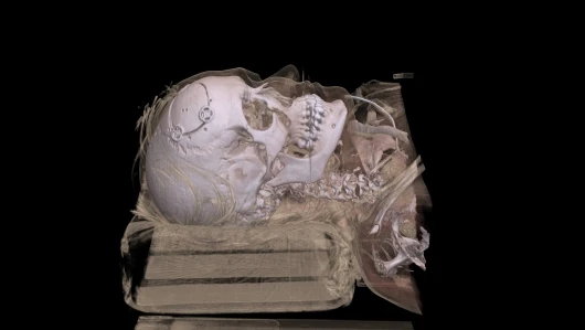 A living patient was treated for cerebral hemorrhaging. The technique makes it possible to virtually remove clothing, skin or blood vessels