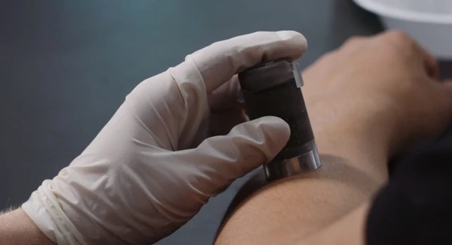 Team Comfortably Numb's skin-numbing device in use (Photo: Rice University)