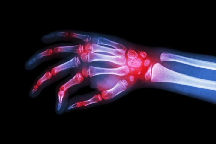 Several in a new class of drugs designed to treat rheumatoid arthritis are inching closer to the market following successful final phase human trial results