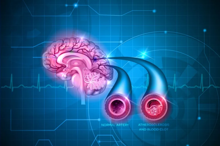 Previous research has link declines in blood flow to the brain with the early stages of Alzheimer’s disease