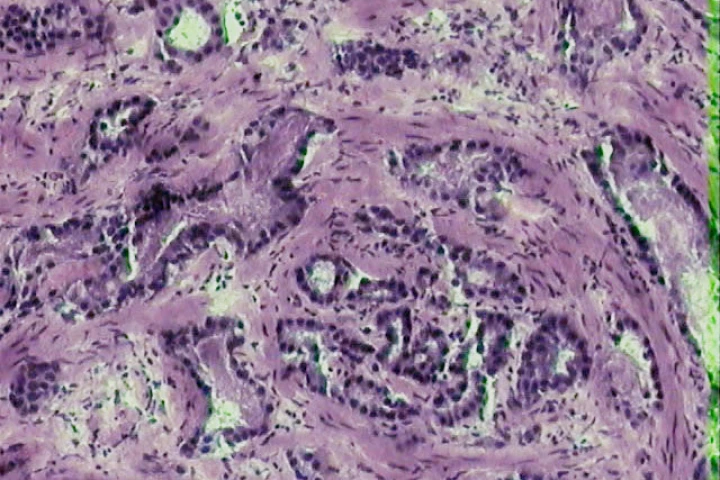 An electronic nose developed by Finnish researchers is capable of distinguishing between prostate cancer and benign disease and could result in a less invasive approach to diagnosis