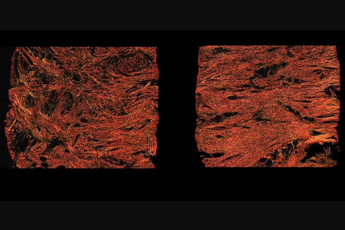 Microscope images of the enmeshed collagen fibers in a scar treated with alphaCT1 (left) and the less flexible aligned fibers in a scar treated with a non-medicated gel (right)