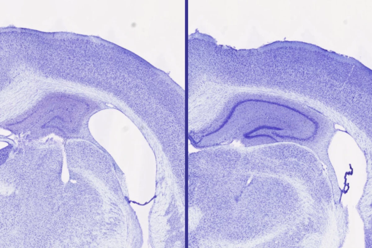 Treatment with lemborexant (right) resulted in larger volume in the hippocampus (central purple spiral) and a smaller gap in brain tissue (white space) compared with another sleep aid treatment (left)