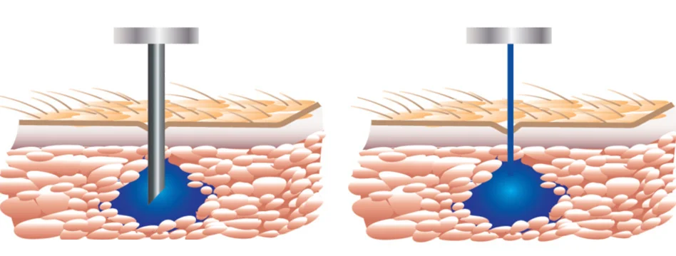 Rather than jam a sharp metal tube through a patient's skin, PRIME delivers its drug payload in the form of a high-pressure stream of liquid