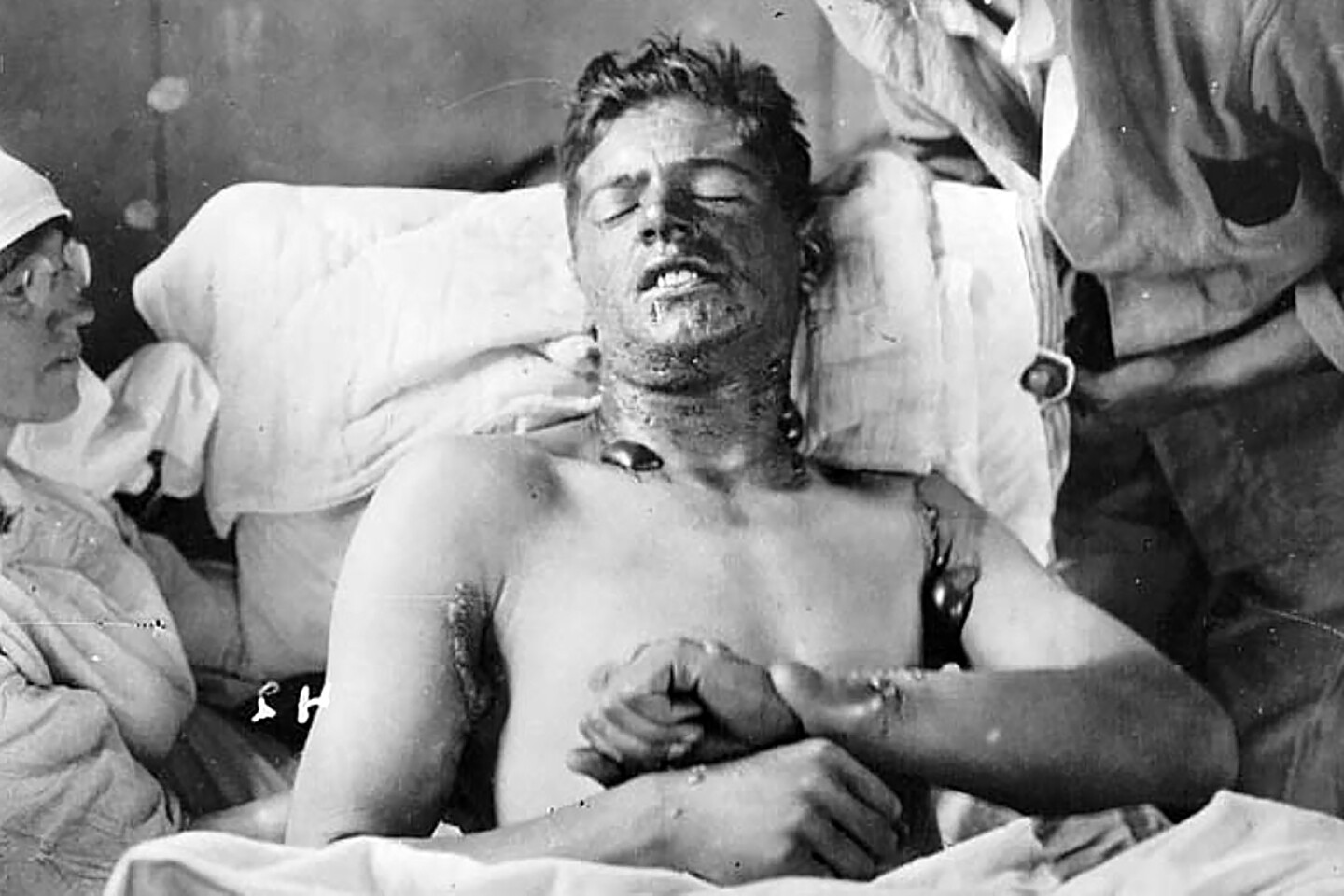 Unidentified Canadian solider with burns caused by mustard gas (ca. 1916-18)