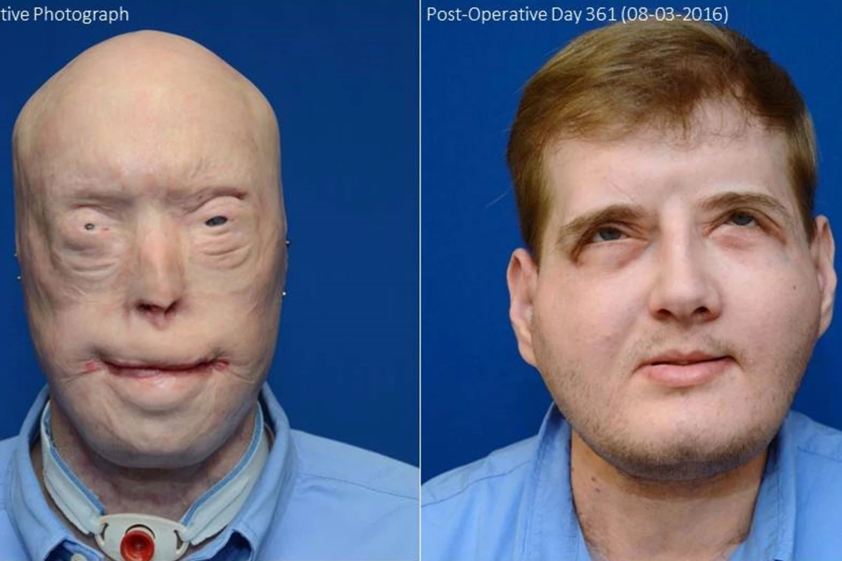 Patrick Hardison before the transplant and a year later