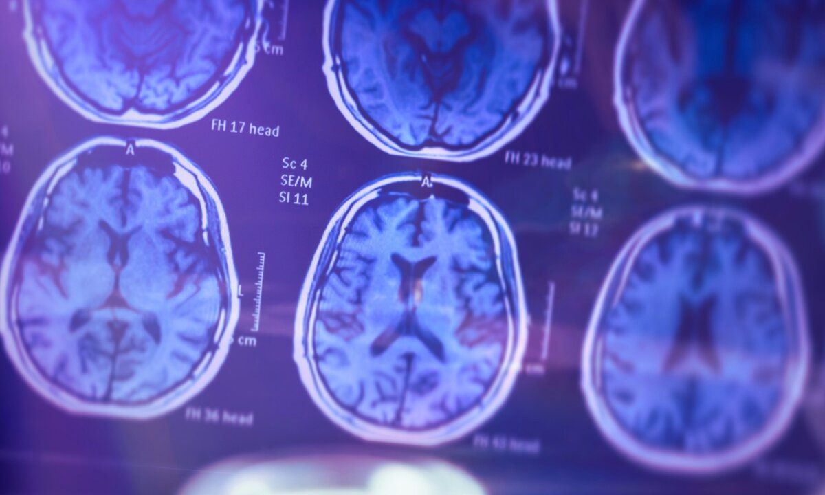 Earliest signs of dementia may be in our blood long before diagnosis